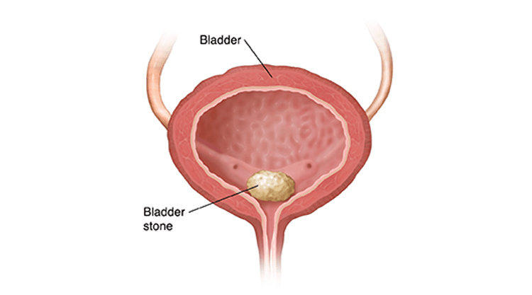 Bladder Stone