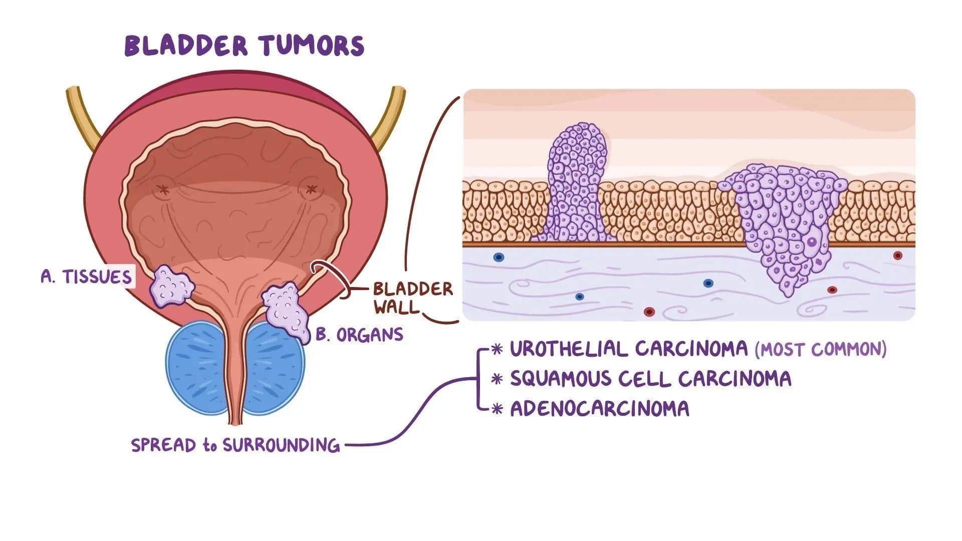 Bladder Tumor