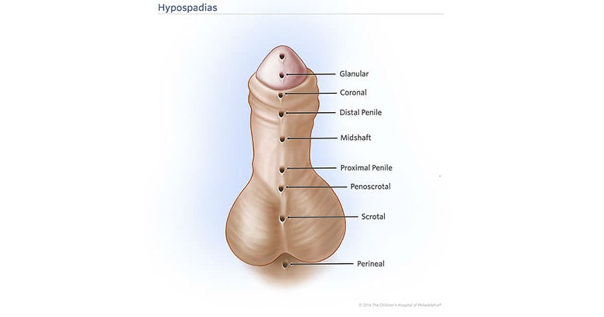 Hypospadias / UDT