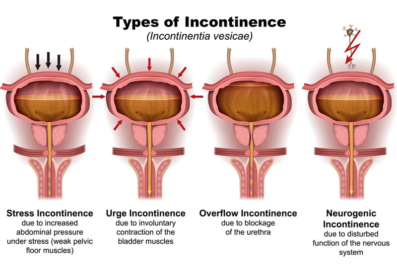 Urinary Incontinence Treatment