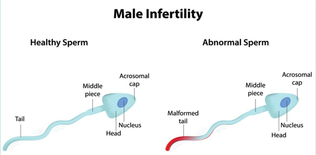 Male Infertility