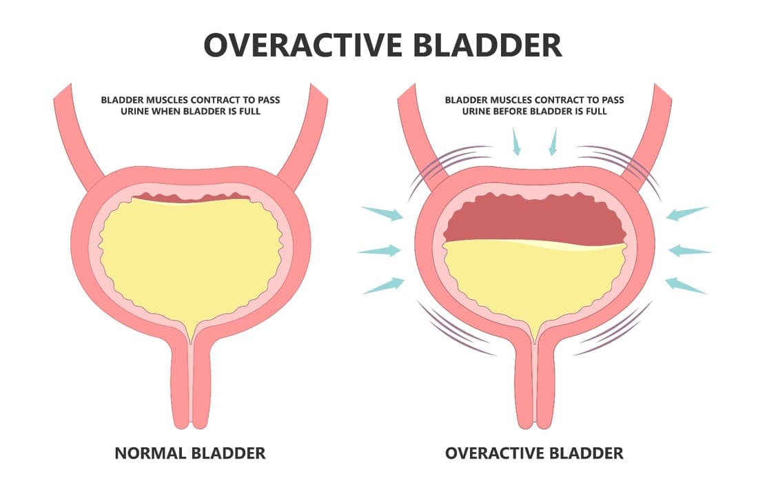 Overactive Bladder Treatment