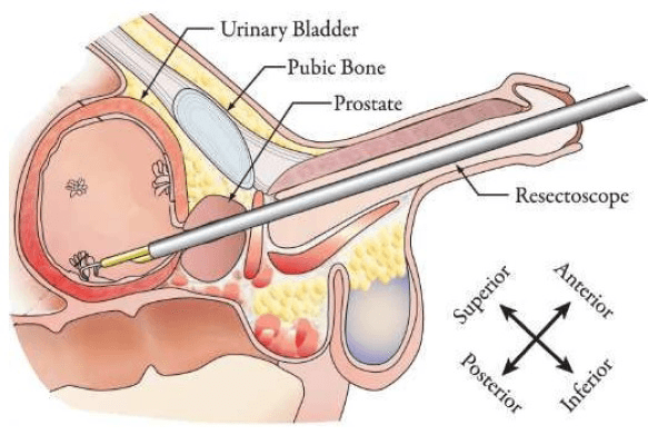 Prostate Surgery (18.5 French)