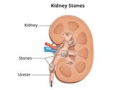 Renal Stone