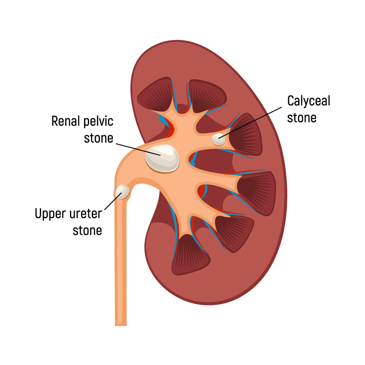 Ureteric Stone