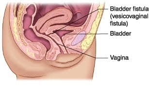 Urinary Fistula (UVF, VVF)